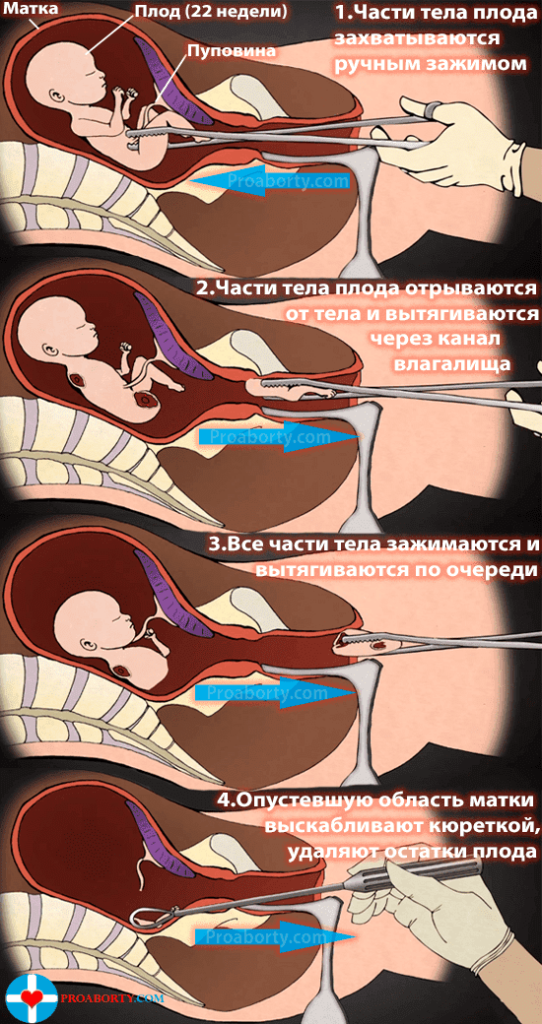 Сколько по времени делается хирургический аборт 28